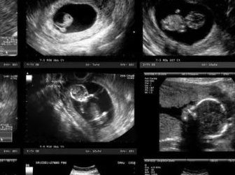 染色体异常不孕能在国内福利会国际和平妇幼保健院做三代试管怀孩子吗？男人染色体有问题能做试管吗？